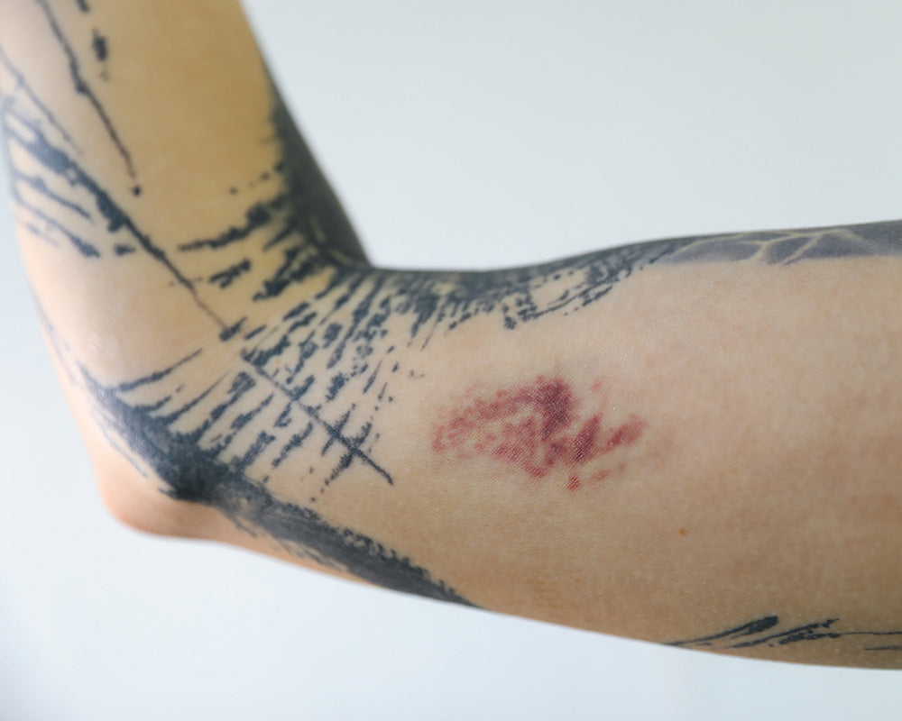 Tattoo Blowout What Is It What Causes It  More  Saniderm